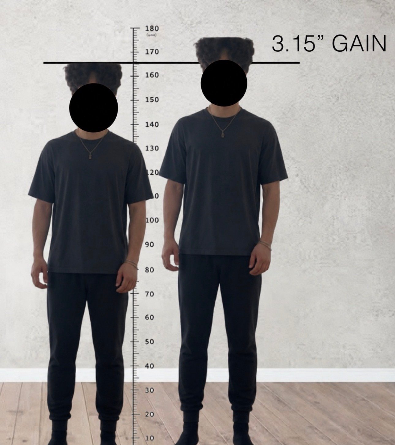 A simulated projection comparing current height (5'5.5") to the planned post-surgery height (5'9"). Not an actual postoperative photo.